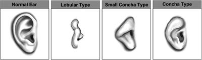 The psychosocial impact of microtia and ear reconstruction: A national data-linkage study